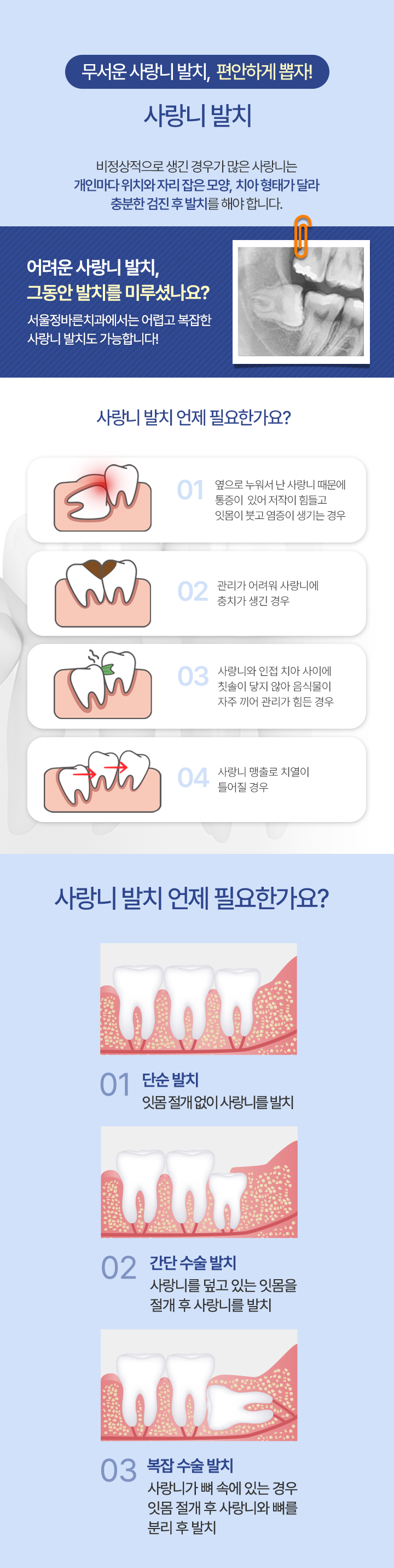 사랑니 발치