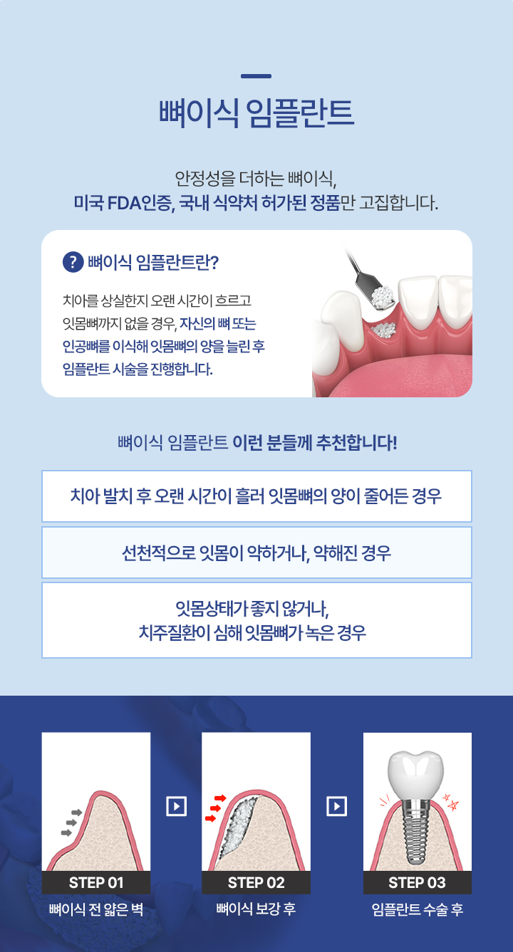 뼈이식 임플란트