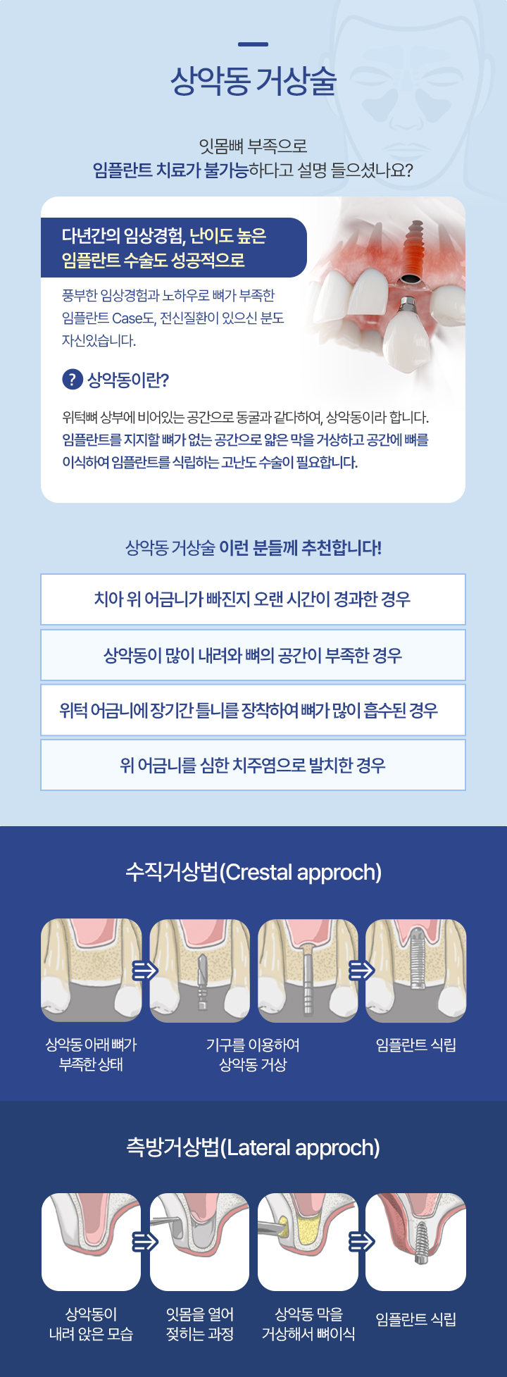 상악동 거상술