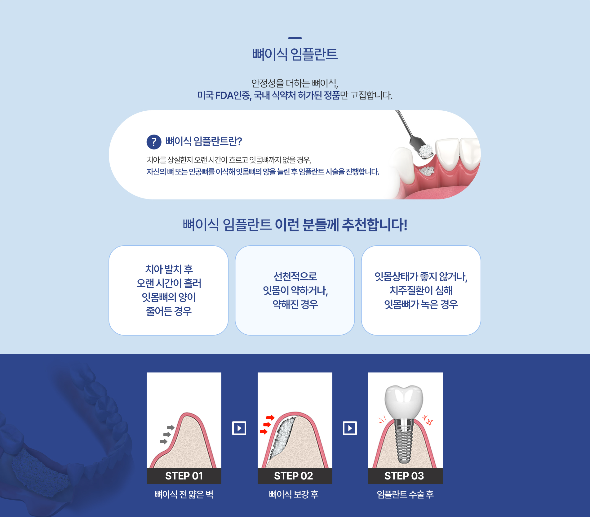 뼈이식 임플란트
