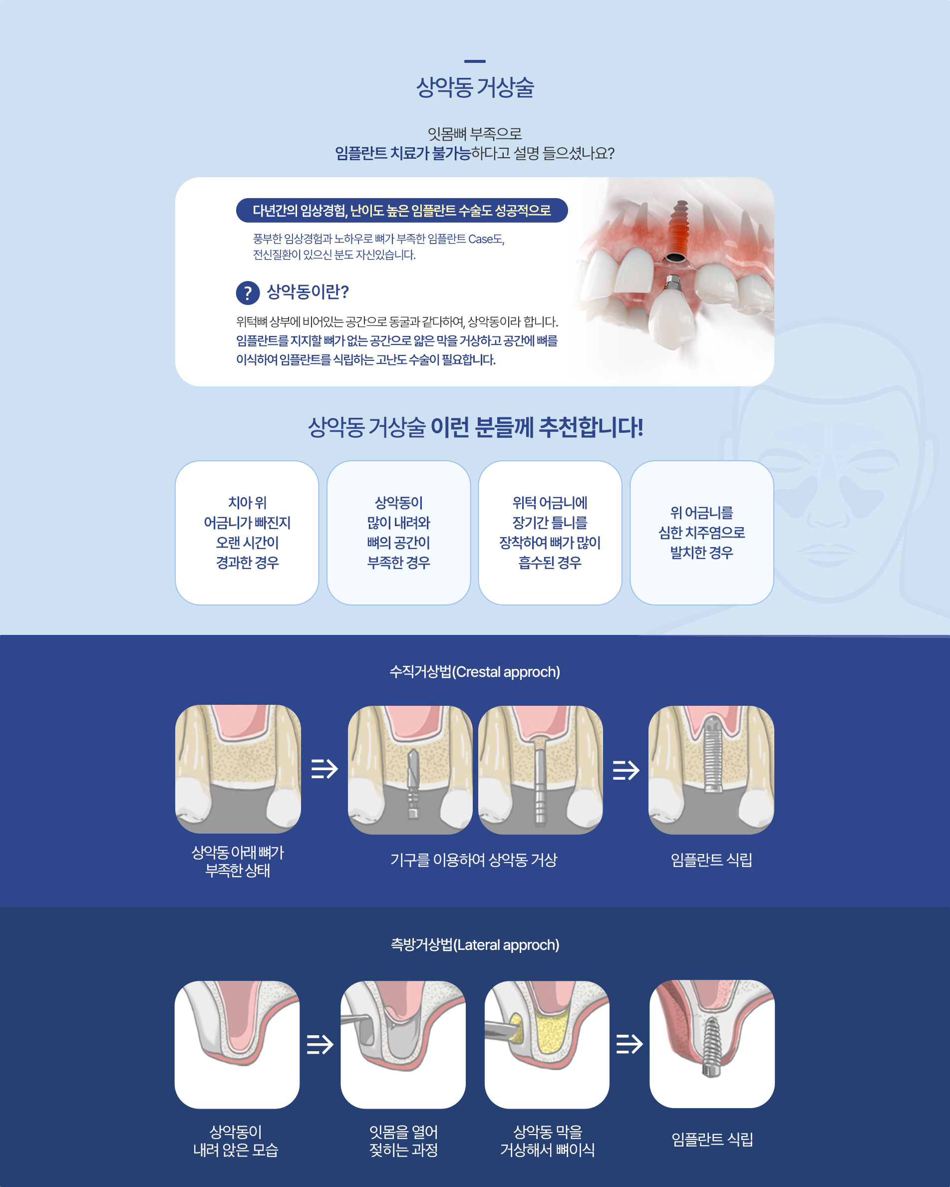 상악동 거상술