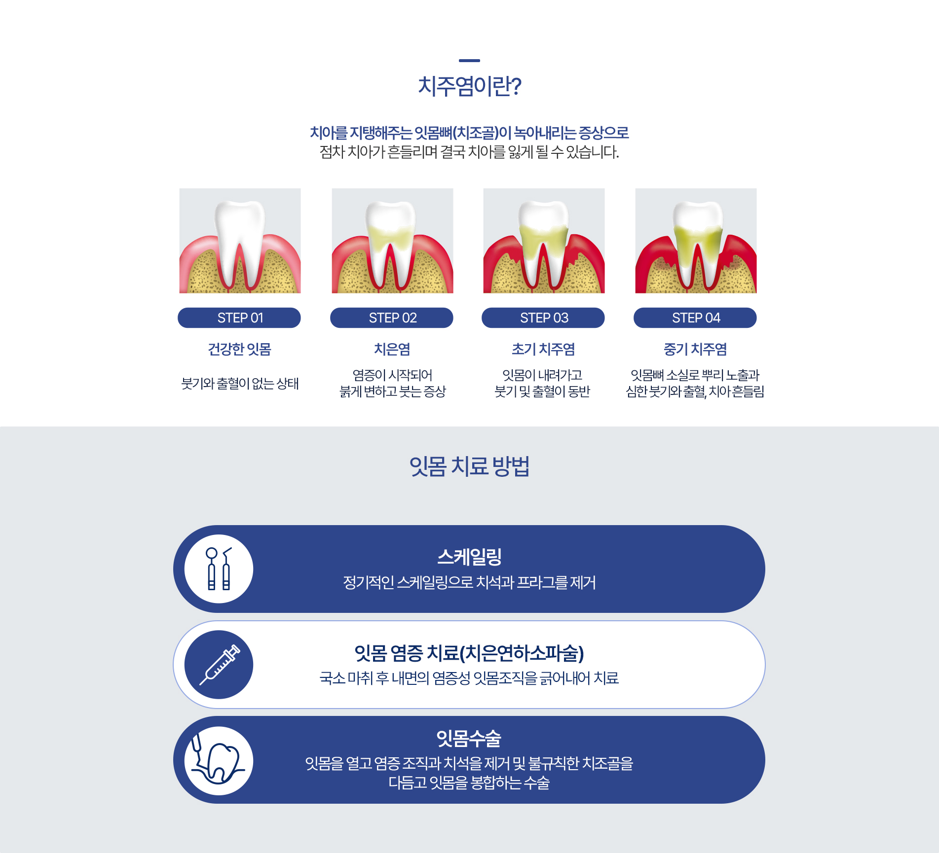 치주염이란?