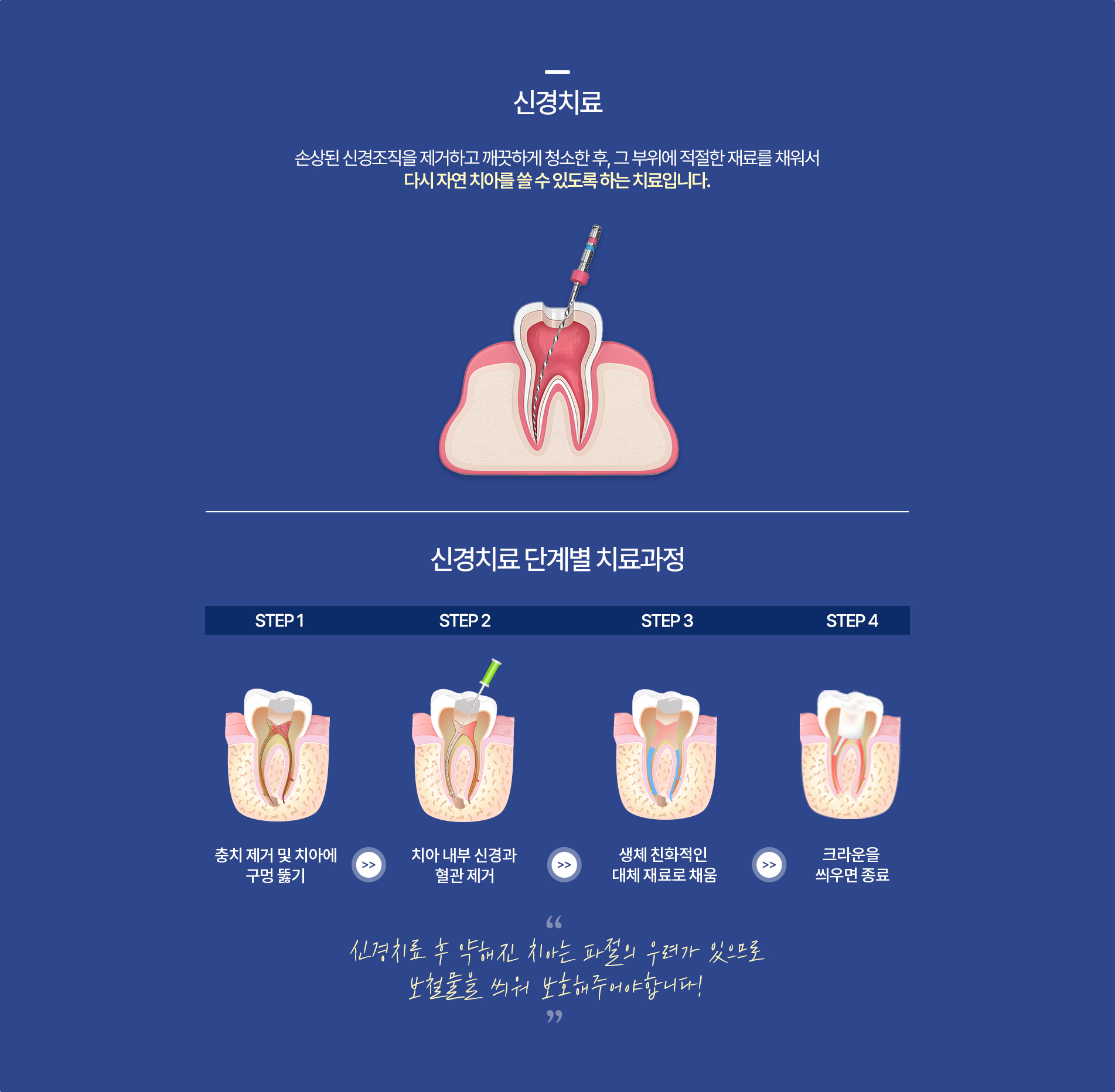신경치료